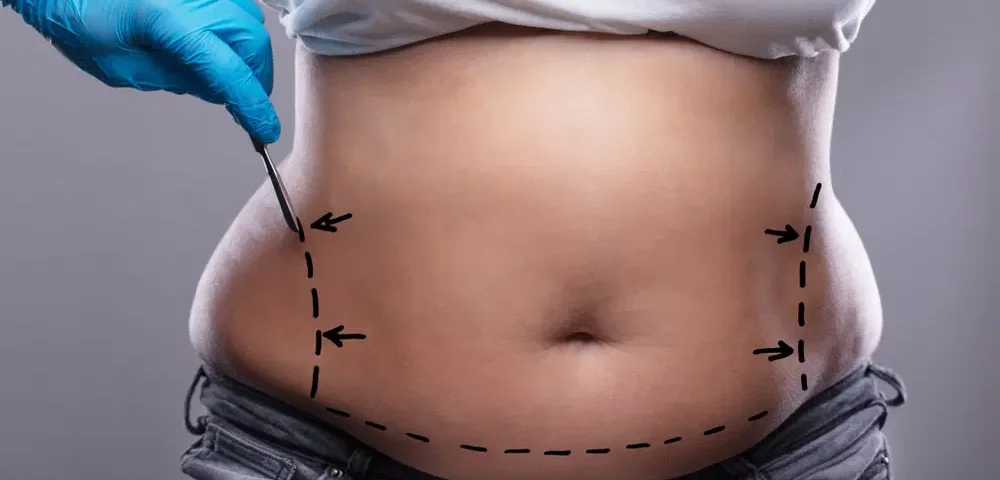 Chirurgie esthétique liposuccion ventre Tunisie prix