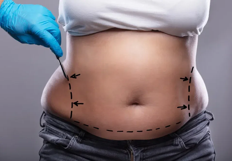 Chirurgie esthétique liposuccion ventre Tunisie prix